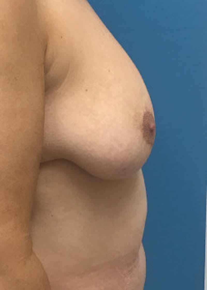 Breast Lift Before & After Gallery - Patient 46620392 - Image 3