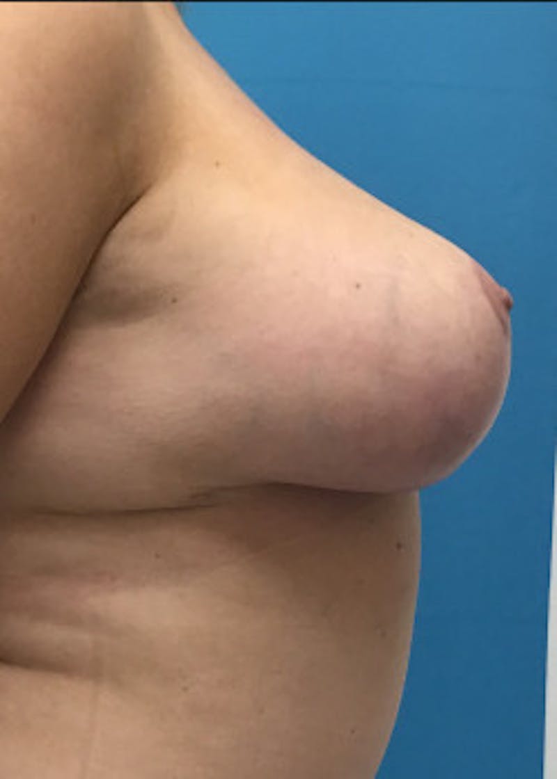 Breast Lift Before & After Gallery - Patient 46620392 - Image 4