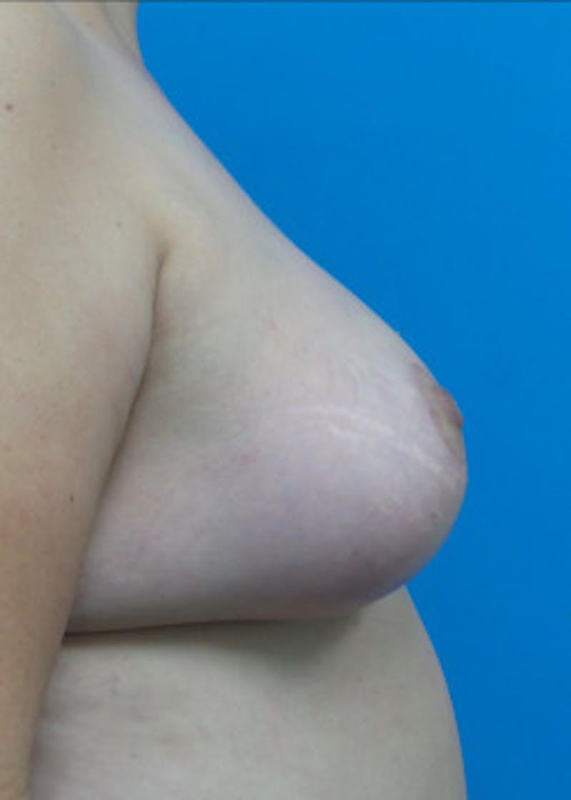 Breast Lift Before & After Gallery - Patient 46620397 - Image 4
