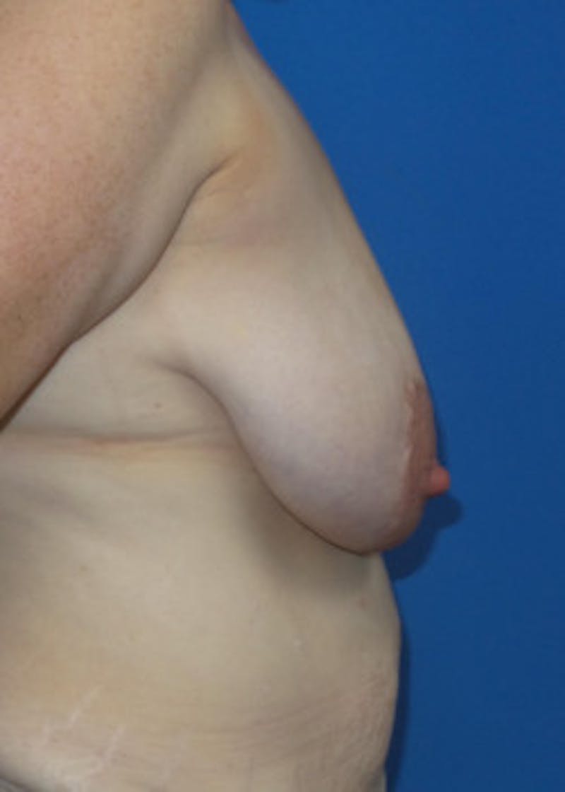 Breast Lift Before & After Gallery - Patient 46620451 - Image 3