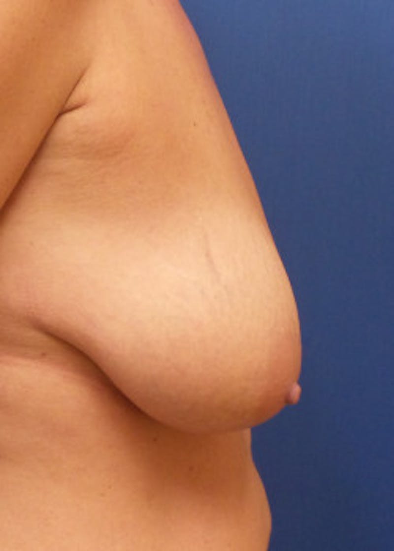 Breast Lift Before & After Gallery - Patient 46620490 - Image 3