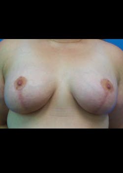 Breast Lift Gallery - Patient 46620510 - Image 2