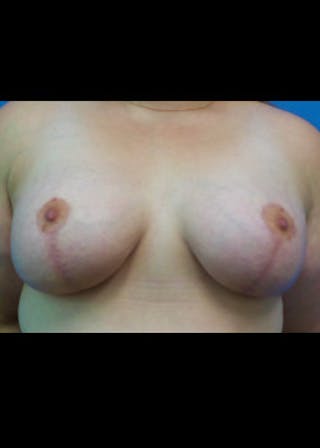 Breast Lift Before & After Gallery - Patient 46620510 - Image 2