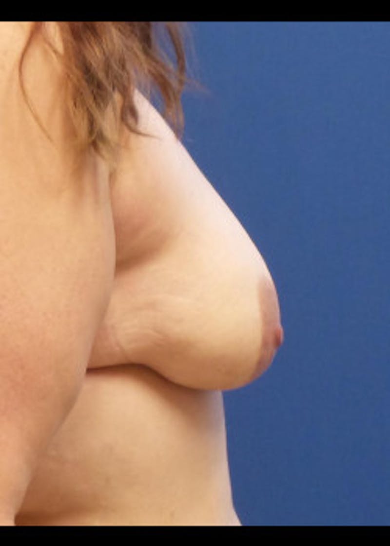 Breast Lift Before & After Gallery - Patient 46620510 - Image 3