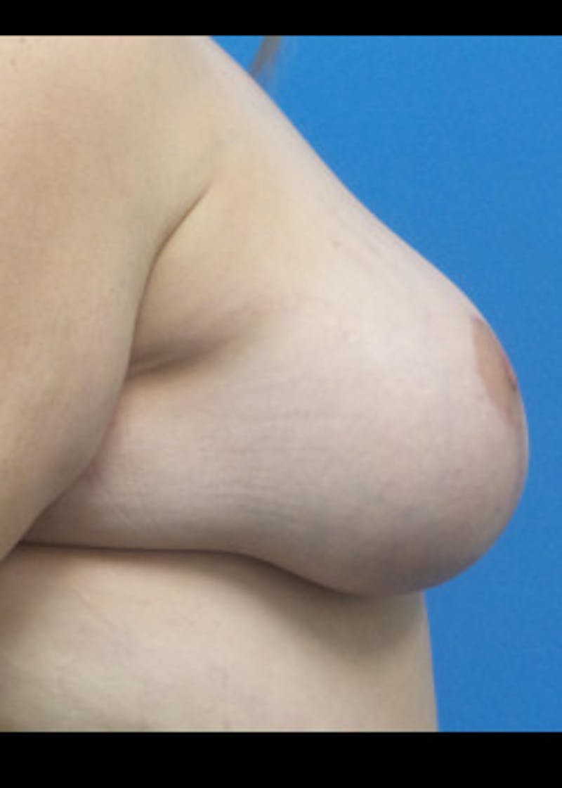 Breast Lift Before & After Gallery - Patient 46620510 - Image 4