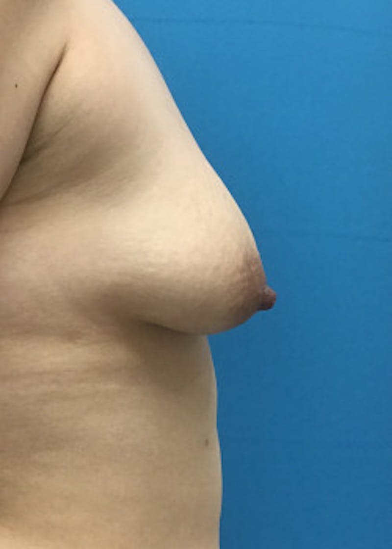 Breast Lift Before & After Gallery - Patient 46620535 - Image 3