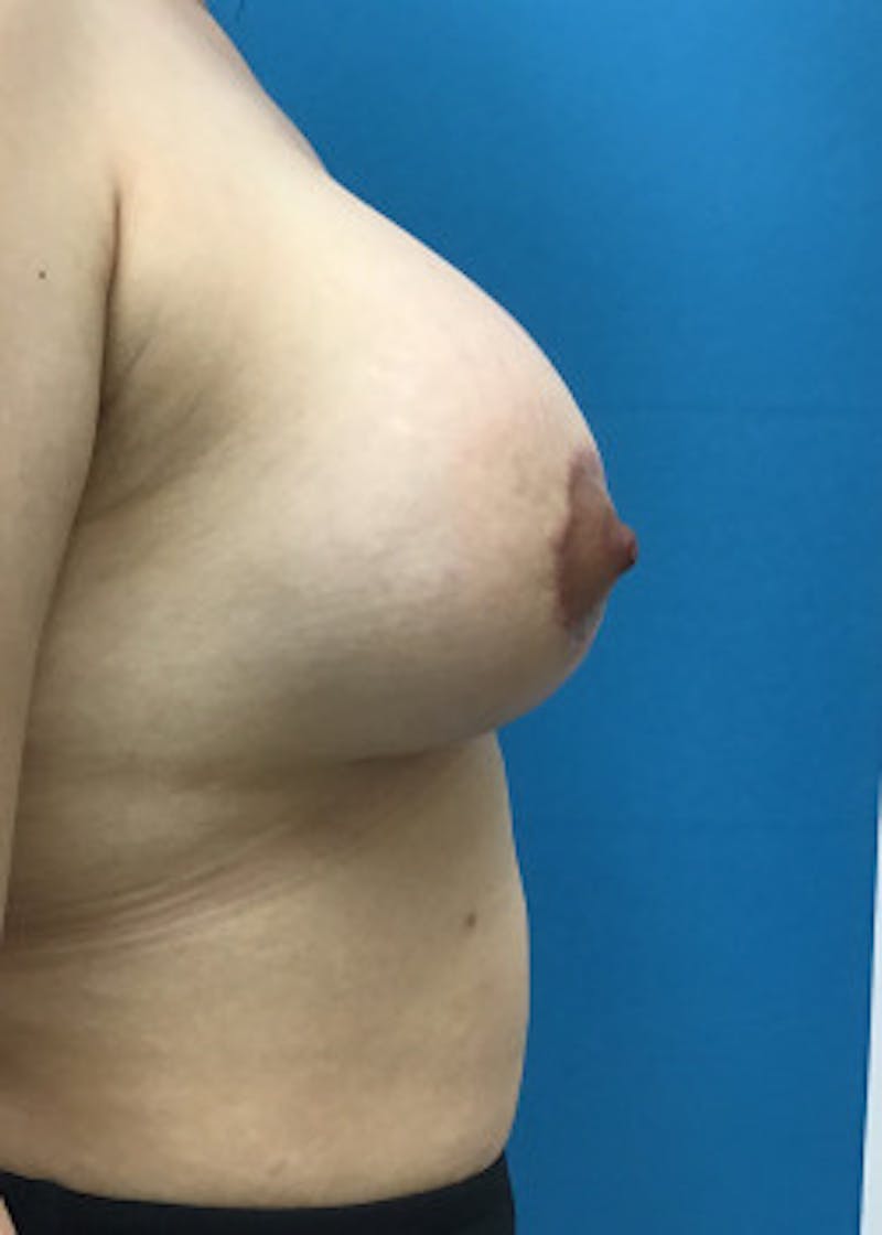 Breast Lift Before & After Gallery - Patient 46620535 - Image 4
