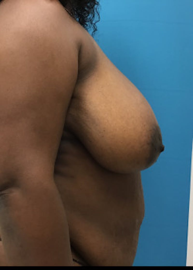 Breast Lift Before & After Gallery - Patient 46620564 - Image 3