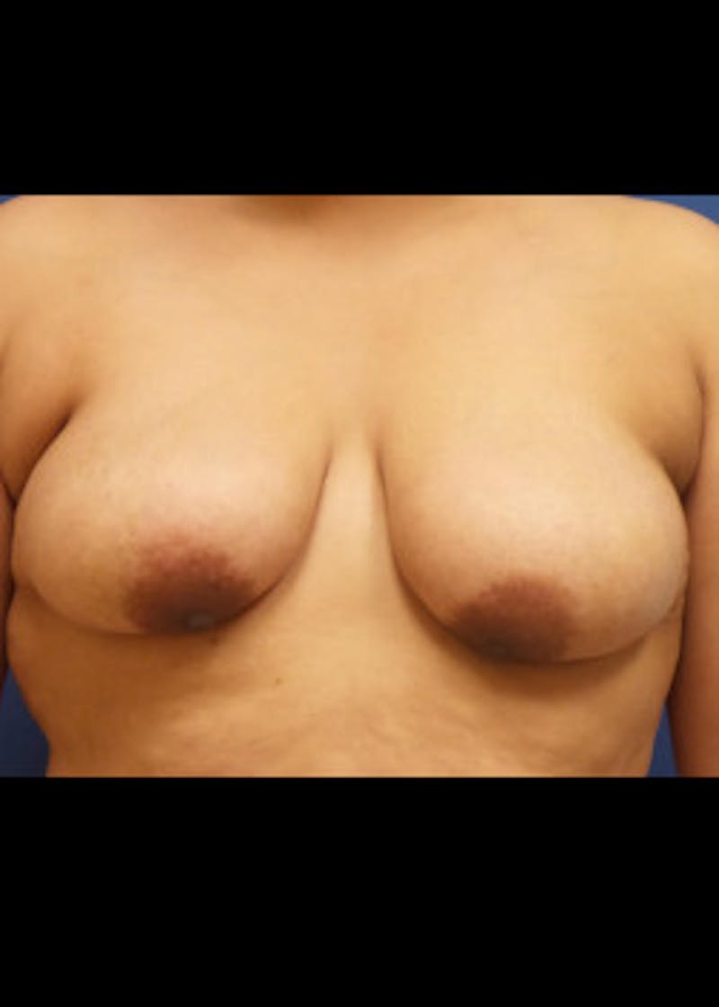 Breast Lift Before & After Gallery - Patient 46620584 - Image 1