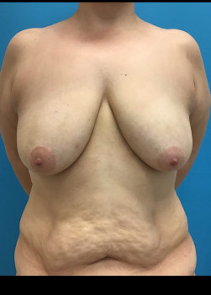 Breast Lift Before & After Gallery - Patient 46621324 - Image 1