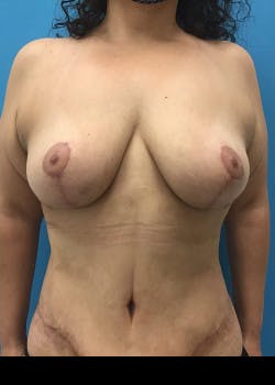 Breast Lift