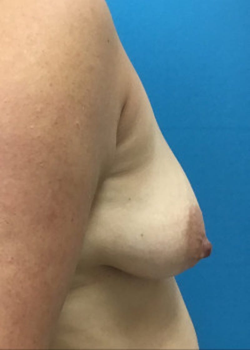 Breast Lift Before & After Gallery - Patient 46621328 - Image 1