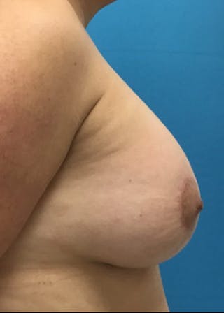 Breast Lift Before & After Gallery - Patient 46621328 - Image 4