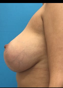 Breast Lift Gallery - Patient 46621329 - Image 4