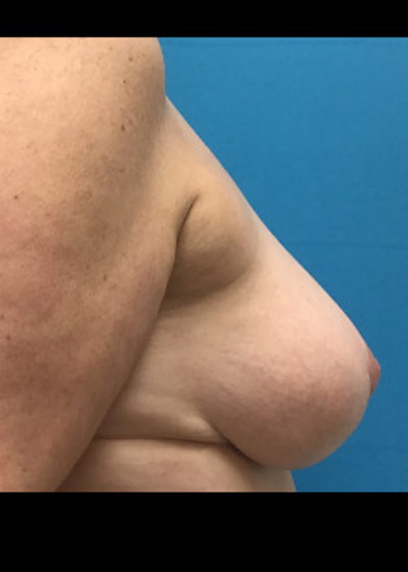 Breast Lift Before & After Gallery - Patient 46621330 - Image 4