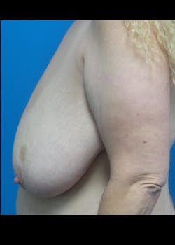Breast Lift Gallery - Patient 46621331 - Image 1