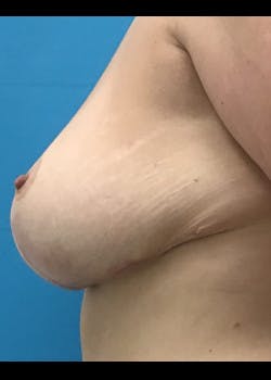Breast Lift Gallery - Patient 46621331 - Image 2