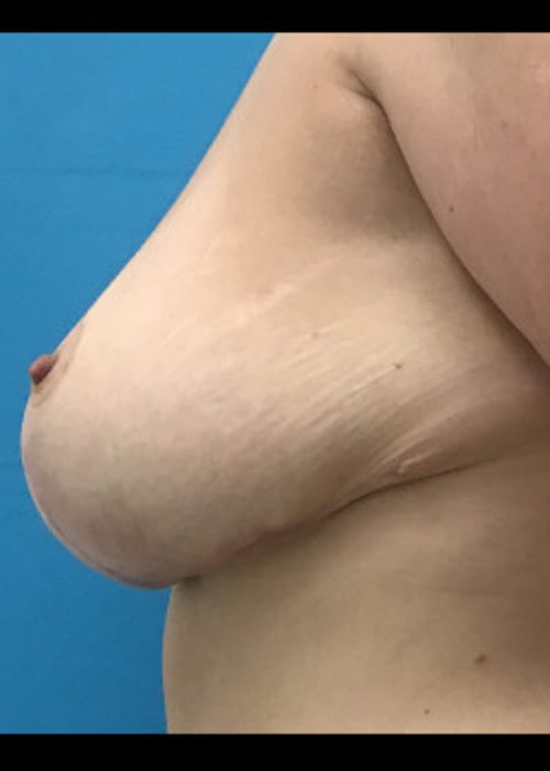 Breast Lift Before & After Gallery - Patient 46621331 - Image 2