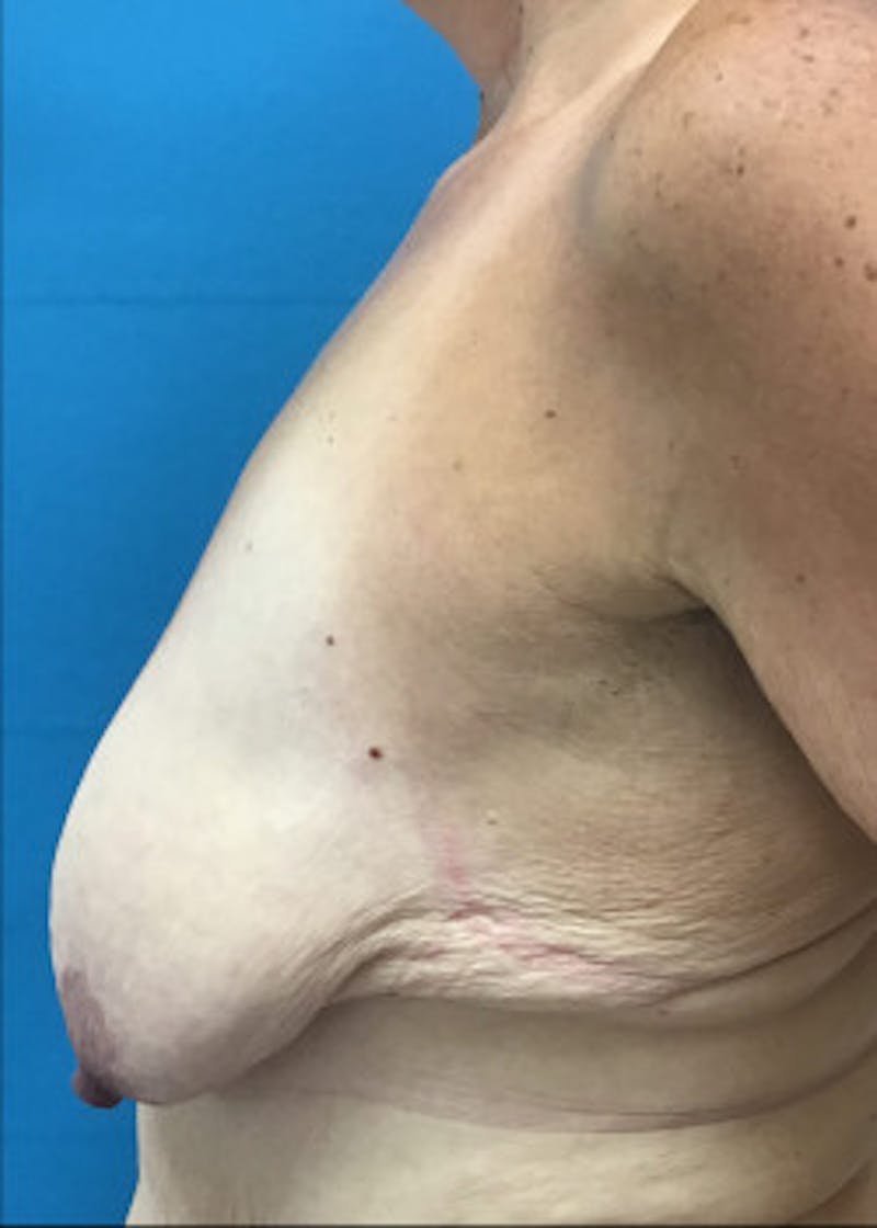 Breast Lift Before & After Gallery - Patient 46621332 - Image 3