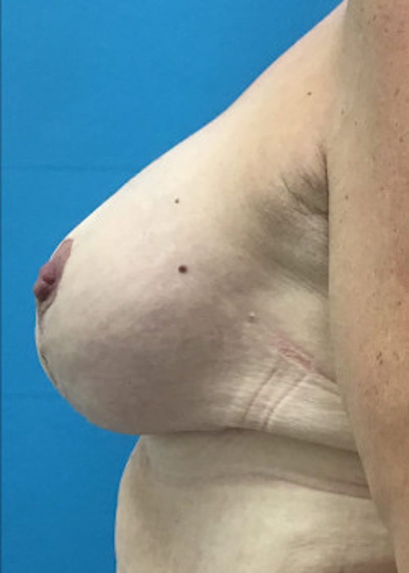 Breast Lift Before & After Gallery - Patient 46621332 - Image 4