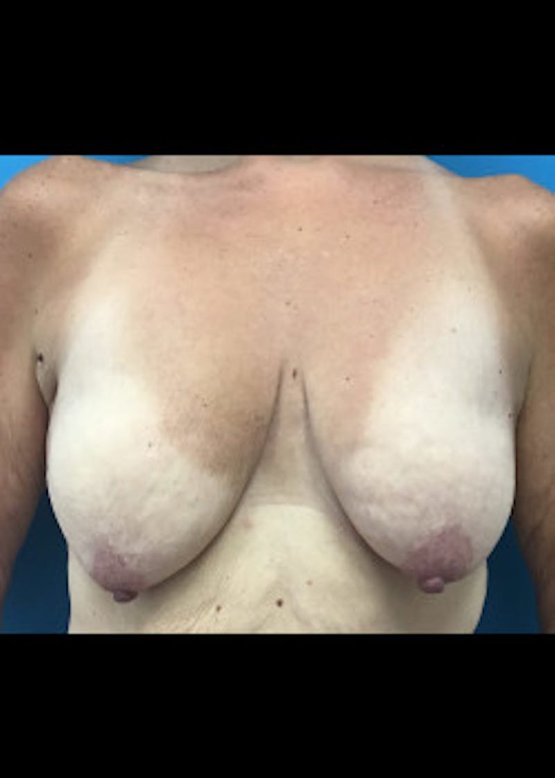 Breast Lift Before & After Gallery - Patient 46621332 - Image 2