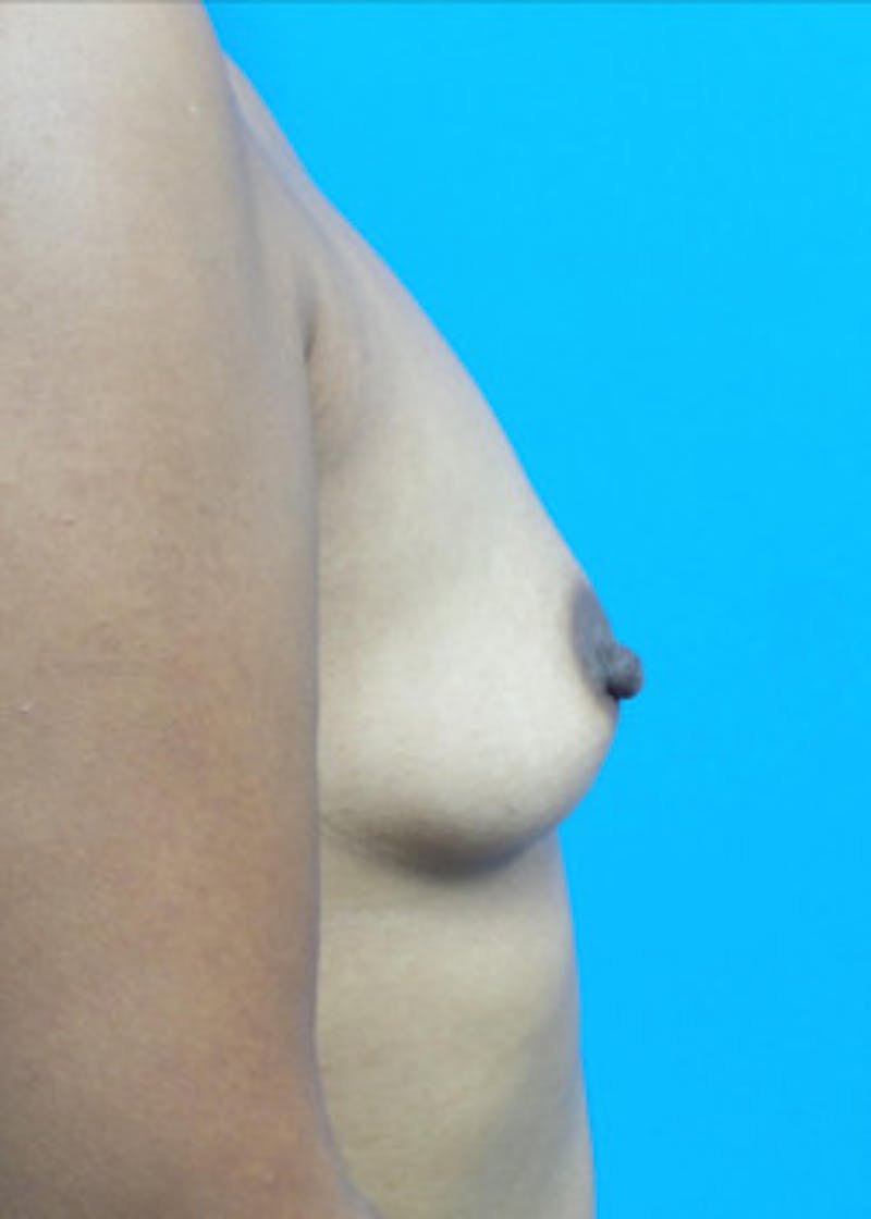 Breast Augmentation Before & After Gallery - Patient 46628858 - Image 3