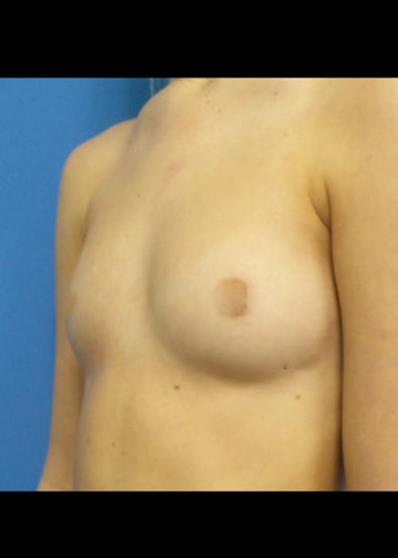 Breast Augmentation Before & After Gallery - Patient 46628906 - Image 1