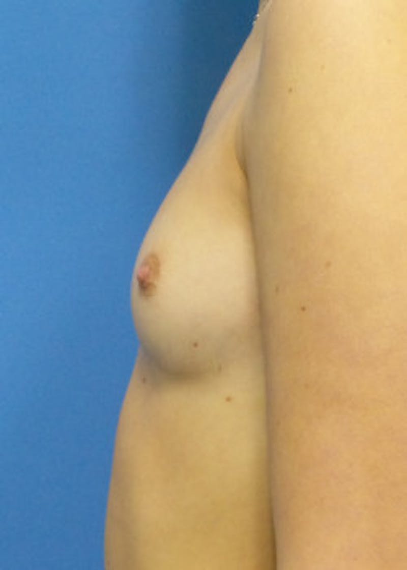 Breast Augmentation Before & After Gallery - Patient 46628906 - Image 3