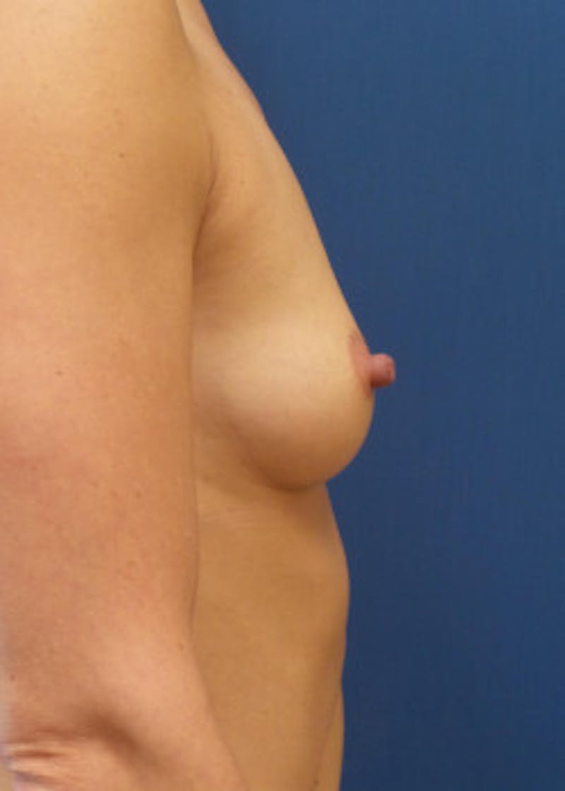 Breast Augmentation Before & After Gallery - Patient 46628922 - Image 3
