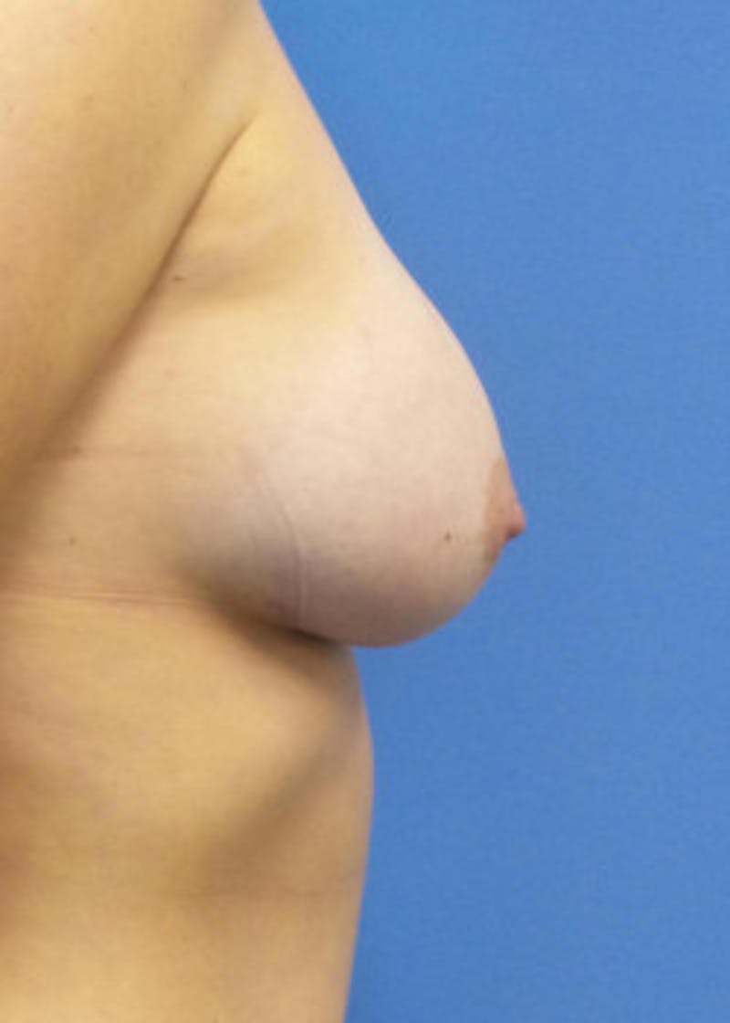Breast Augmentation Before & After Gallery - Patient 46628941 - Image 4