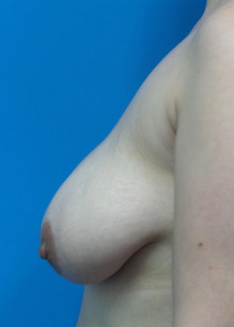 Breast Augmentation Before & After Gallery - Patient 46629133 - Image 3
