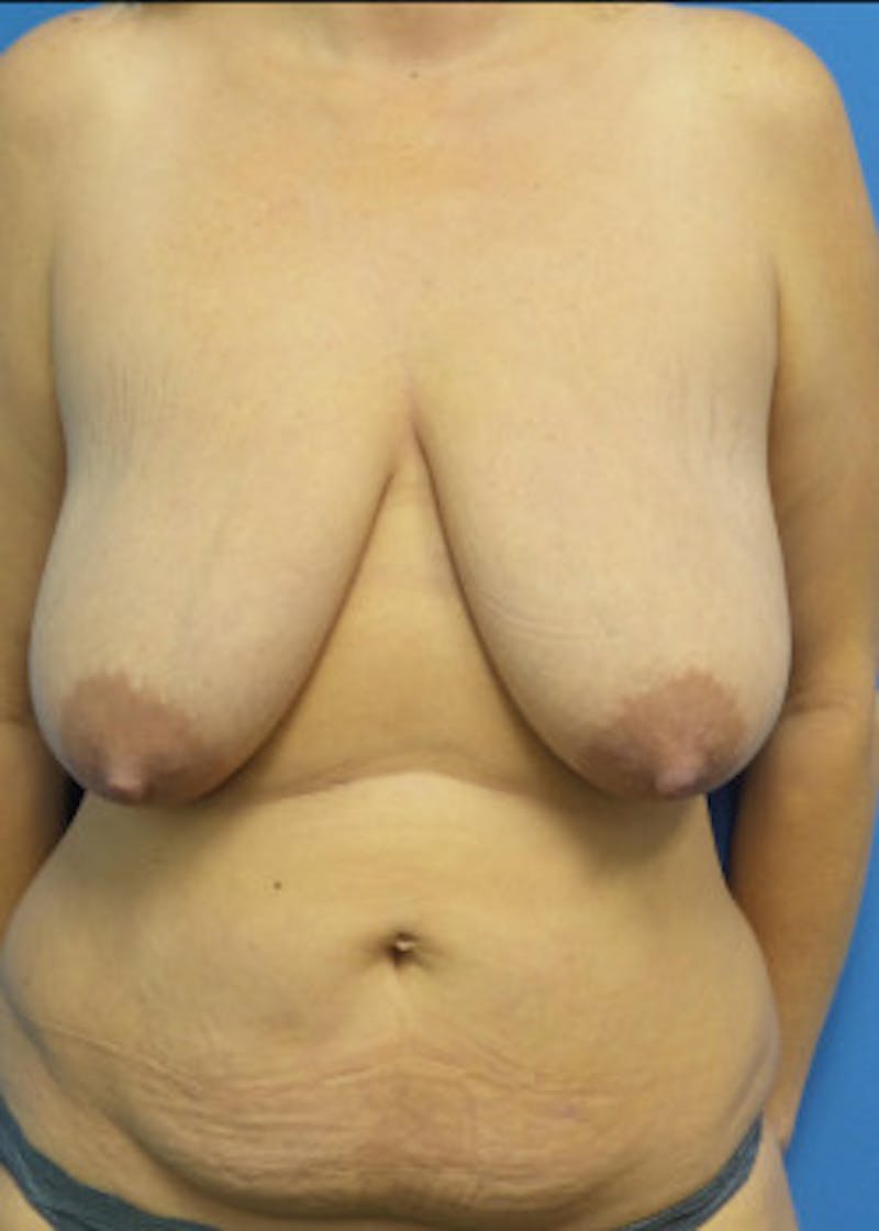 Breast Augmentation Before & After Gallery - Patient 46629161 - Image 1