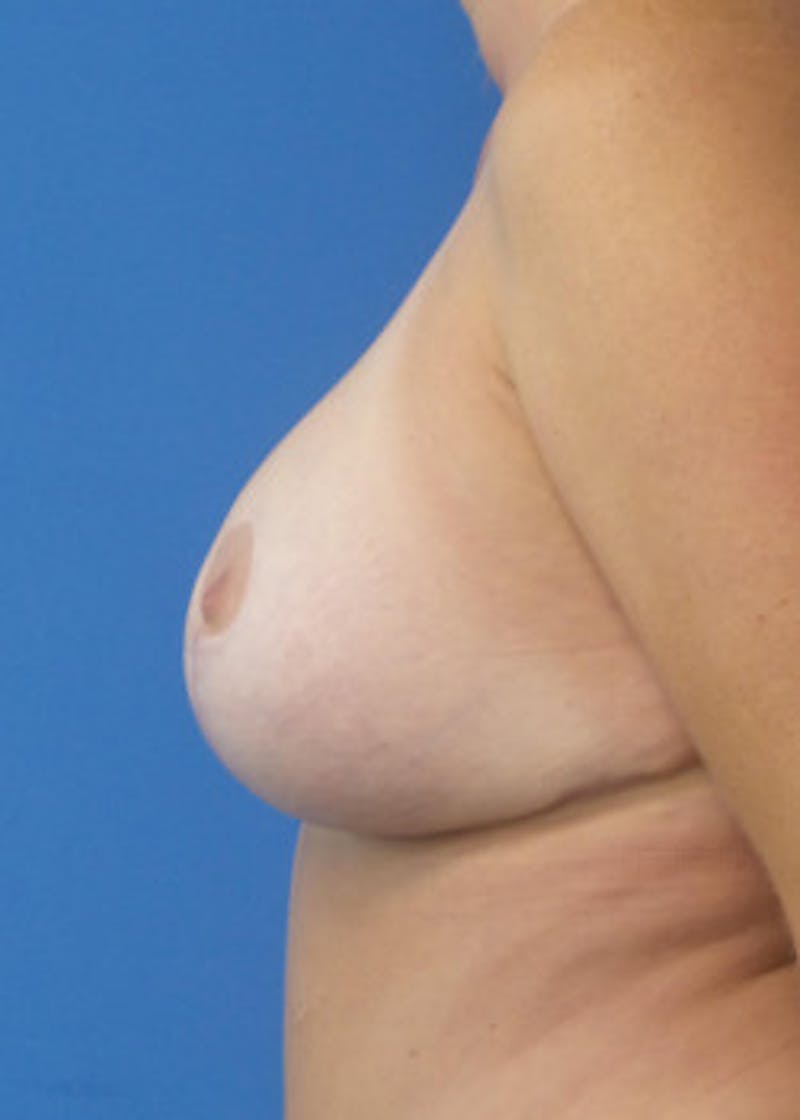Breast Augmentation Before & After Gallery - Patient 46629161 - Image 4