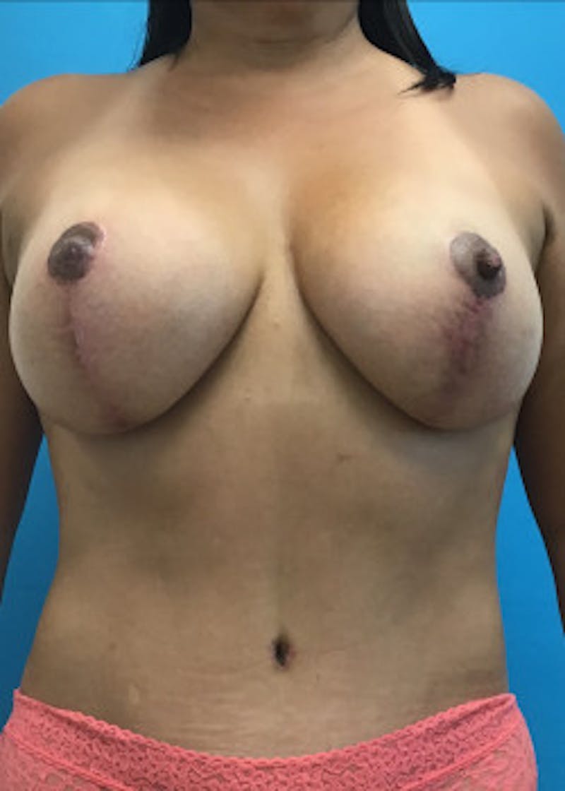 Breast Augmentation Before & After Gallery - Patient 46629195 - Image 2