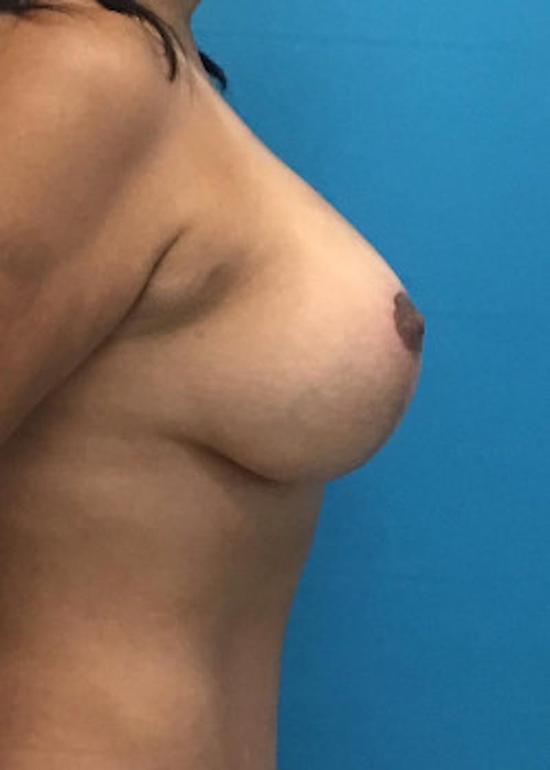 Breast Augmentation Before & After Gallery - Patient 46629195 - Image 4