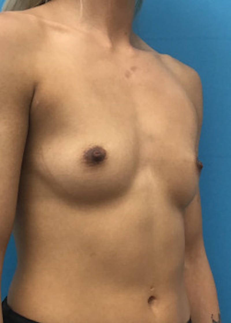Breast Augmentation Before & After Gallery - Patient 46629323 - Image 1