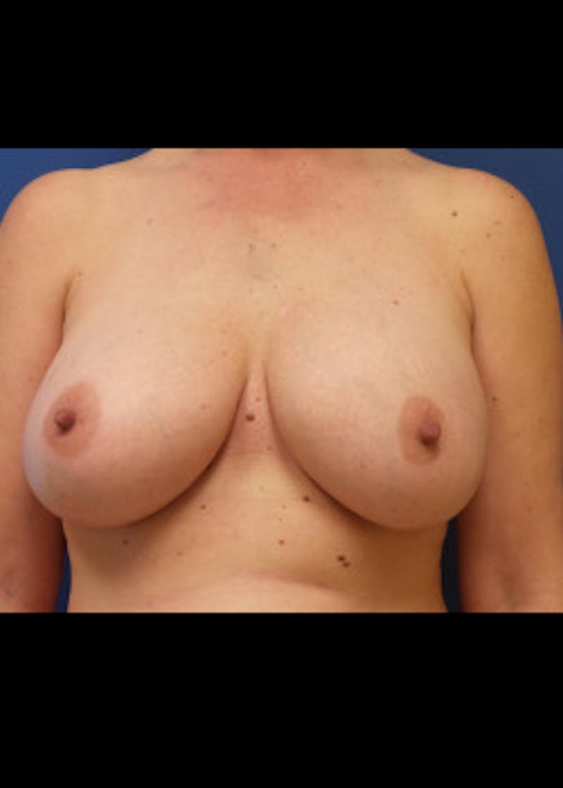 Breast Augmentation Before & After Gallery - Patient 46629329 - Image 2