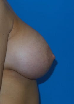 Breast Augmentation Gallery - Patient 46629330 - Image 2
