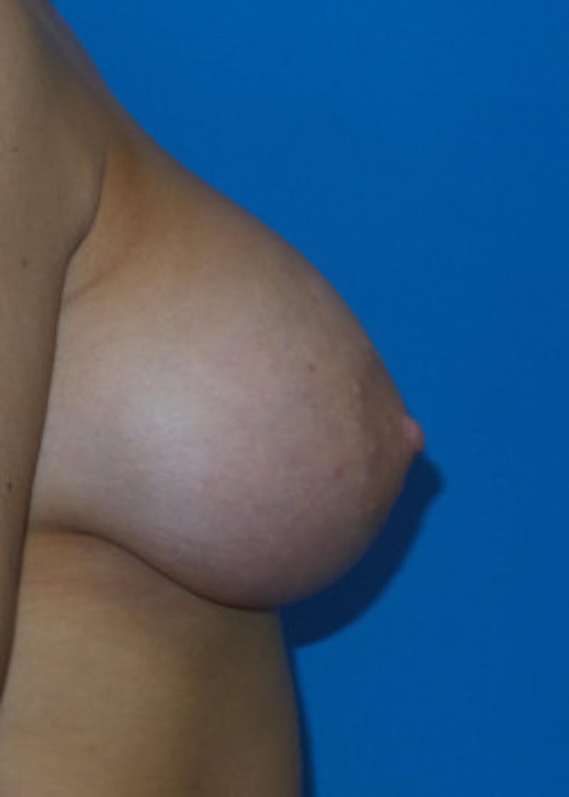 Breast Augmentation Before & After Gallery - Patient 46629330 - Image 2