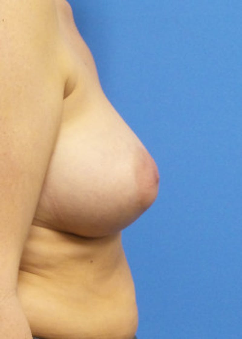 Breast Augmentation Before & After Gallery - Patient 46629331 - Image 4