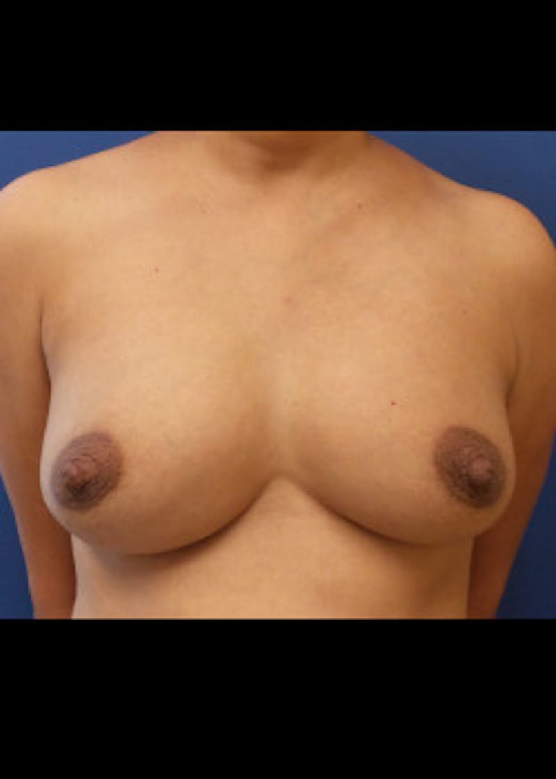 Breast Augmentation Before & After Gallery - Patient 46629332 - Image 1