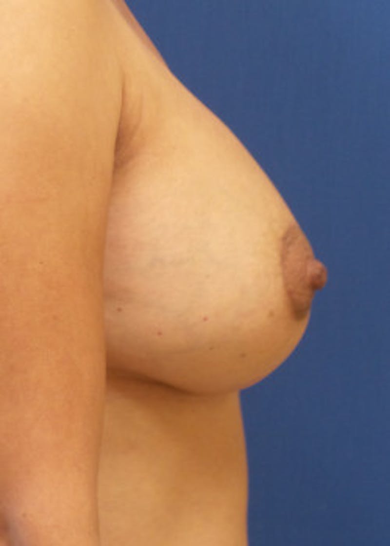 Breast Augmentation Before & After Gallery - Patient 46629332 - Image 4