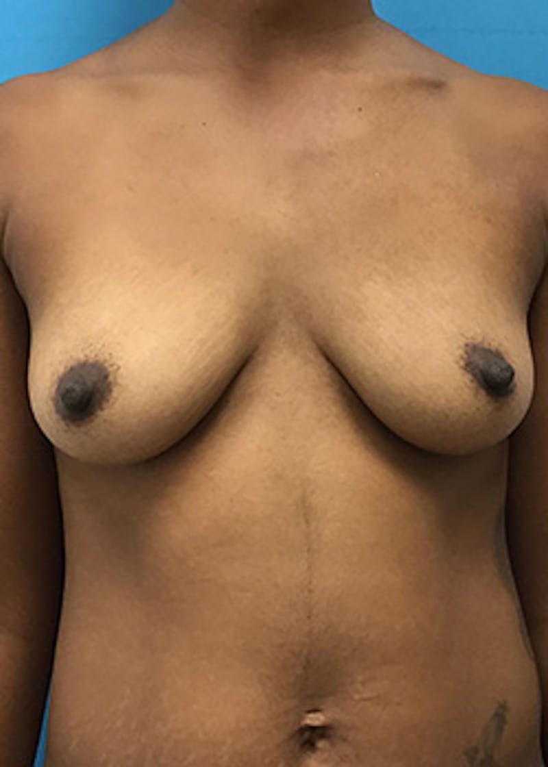 Breast Augmentation Before & After Gallery - Patient 147702725 - Image 1