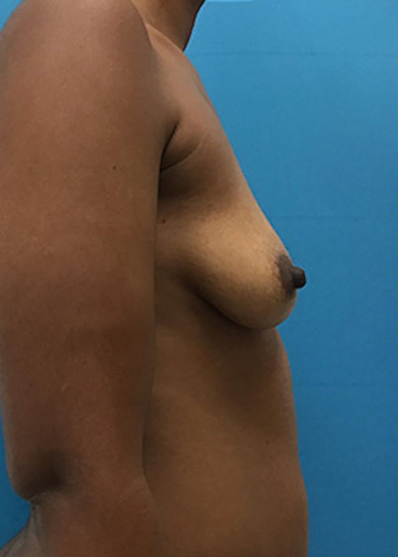 Breast Augmentation Before & After Gallery - Patient 147702725 - Image 5