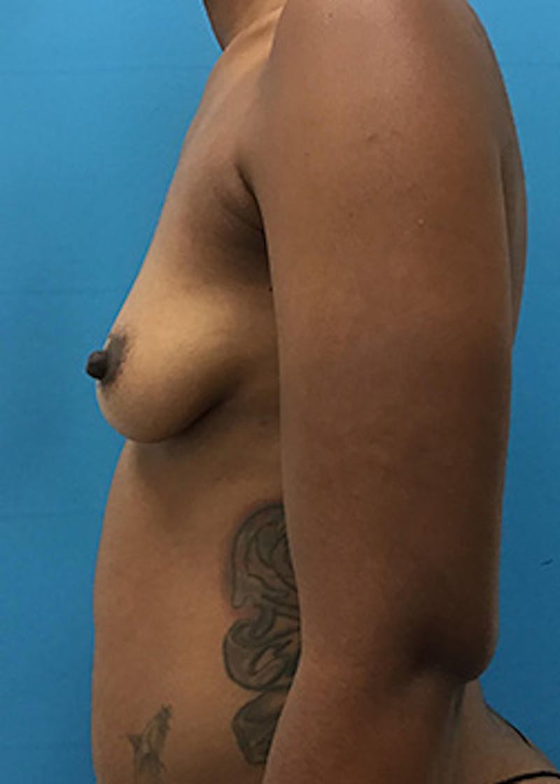 Breast Augmentation Before & After Gallery - Patient 147702725 - Image 9