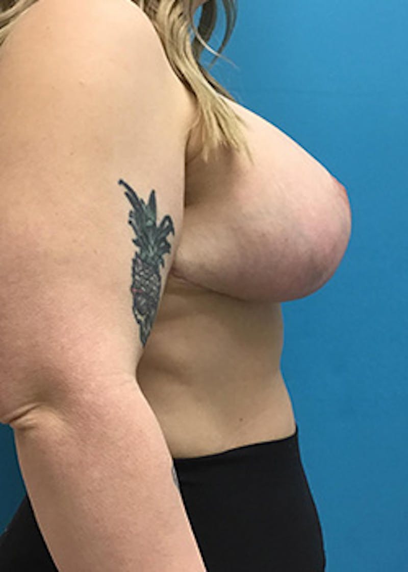 Breast Augmentation Before & After Gallery - Patient 147702724 - Image 6