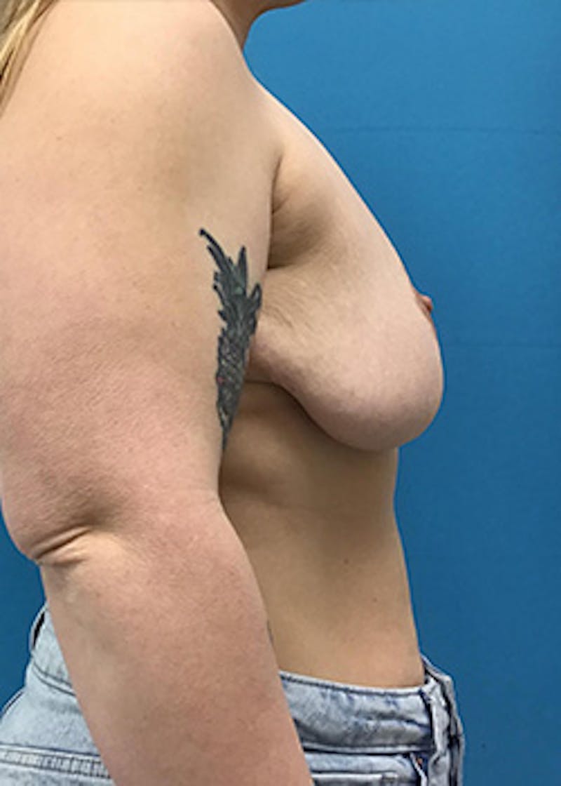 Breast Lift Before & After Gallery - Patient 147702726 - Image 5