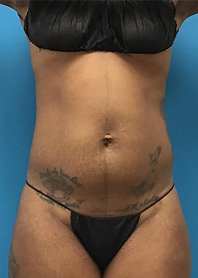 Liposuction Before & After Gallery - Patient 147702771 - Image 1
