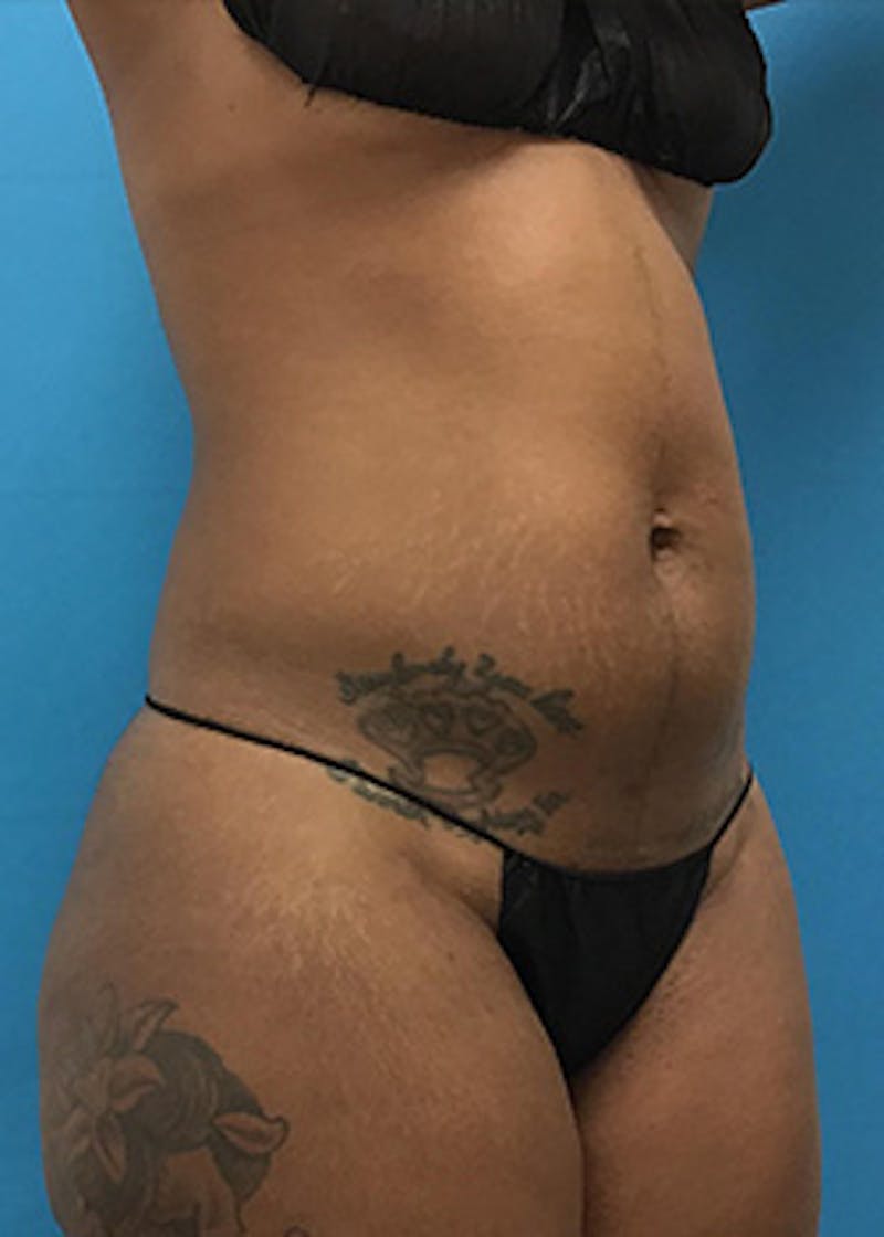 Liposuction Before & After Gallery - Patient 147702771 - Image 3