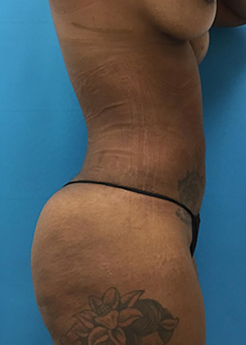 Liposuction Before & After Gallery - Patient 147702771 - Image 6